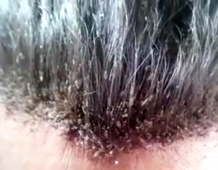 Virales Video „Läuse in den Haaren“