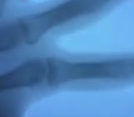 Virales Video „Fingerknacken unter dem Röntgenbild“